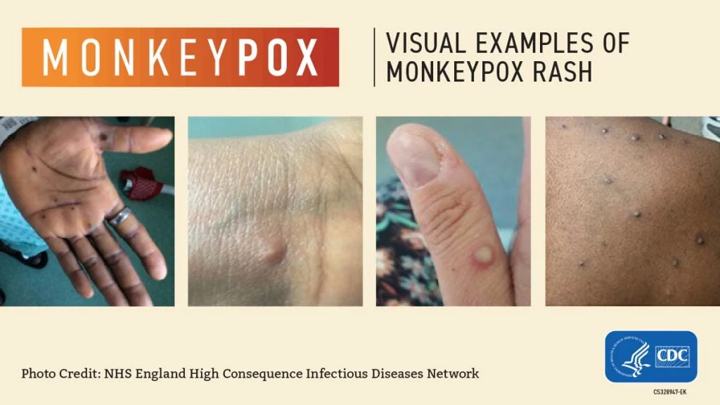 Monkeypox-Visuals-1200x675