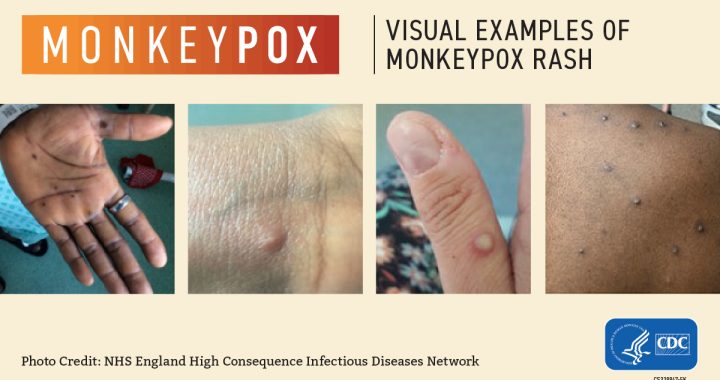Monkeypox-Visuals-1200x675